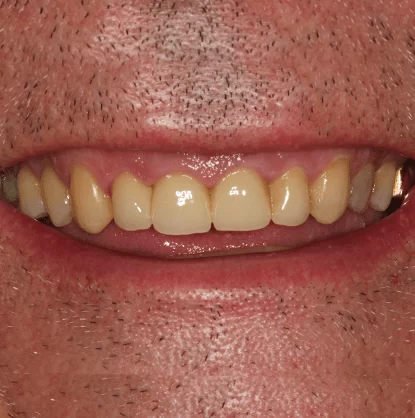 After-Smile-makeover.1-min