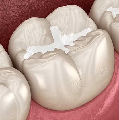 fillings.1-min