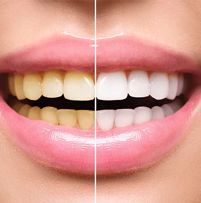 whitening-min