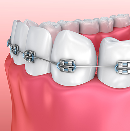 Fixed-braces