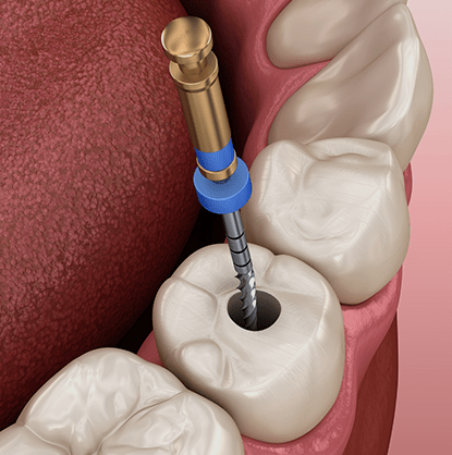 Untitled-2.rootcanal-min
