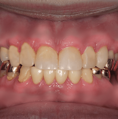 Untitled-3.toothwear.1-min