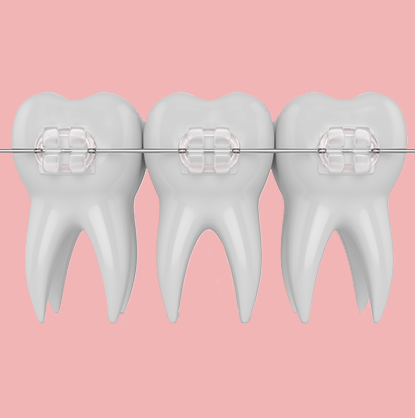 Untitled-5.ceramic-braces-min