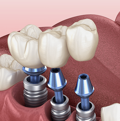 Untitled-5.implants-1.15-min