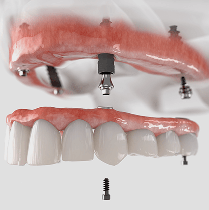 Untitled-implant-retained-min